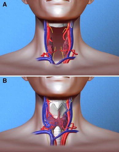  Laryngeal transplant